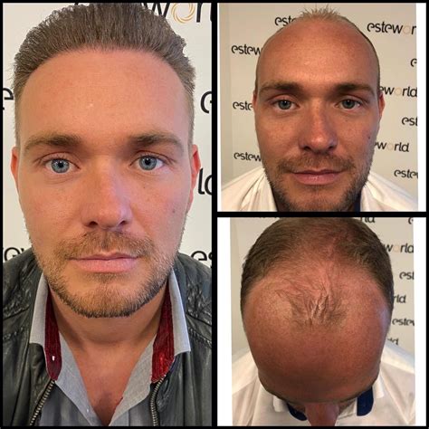 De Beste Tijd Van Het Jaar Voor Haartransplantatie