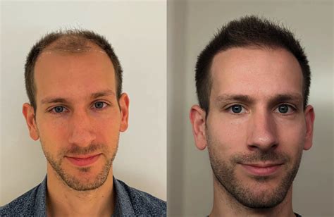 Haartransplantatie DHI: Klantenreviews En Ervaringen